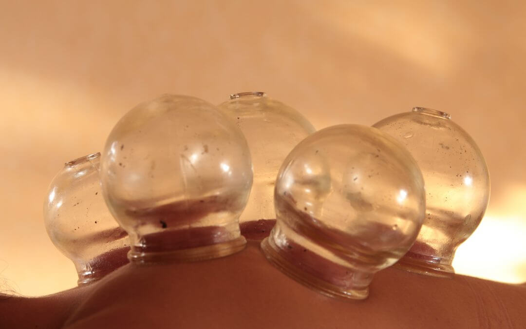 Cupping