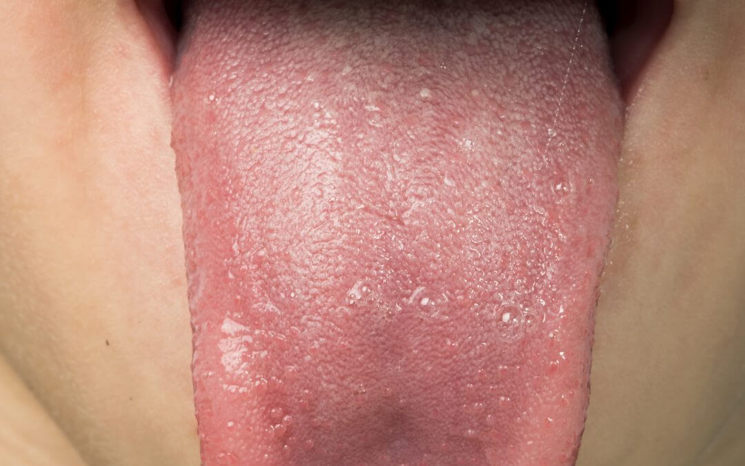 tongue diagnosis